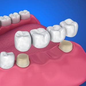 family dentistry alvin dental care alvin tx services dentures and bridges image
