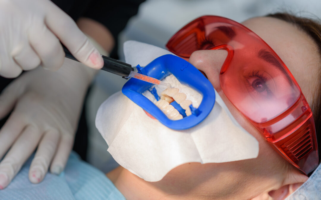 Professional Teeth Whitening: A Smarter Choice Than Store-Bought