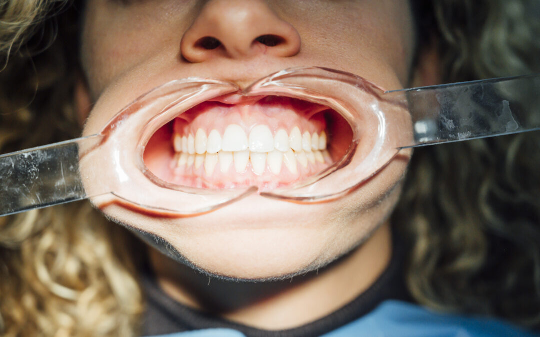 Can Yellow Teeth Become White Again?