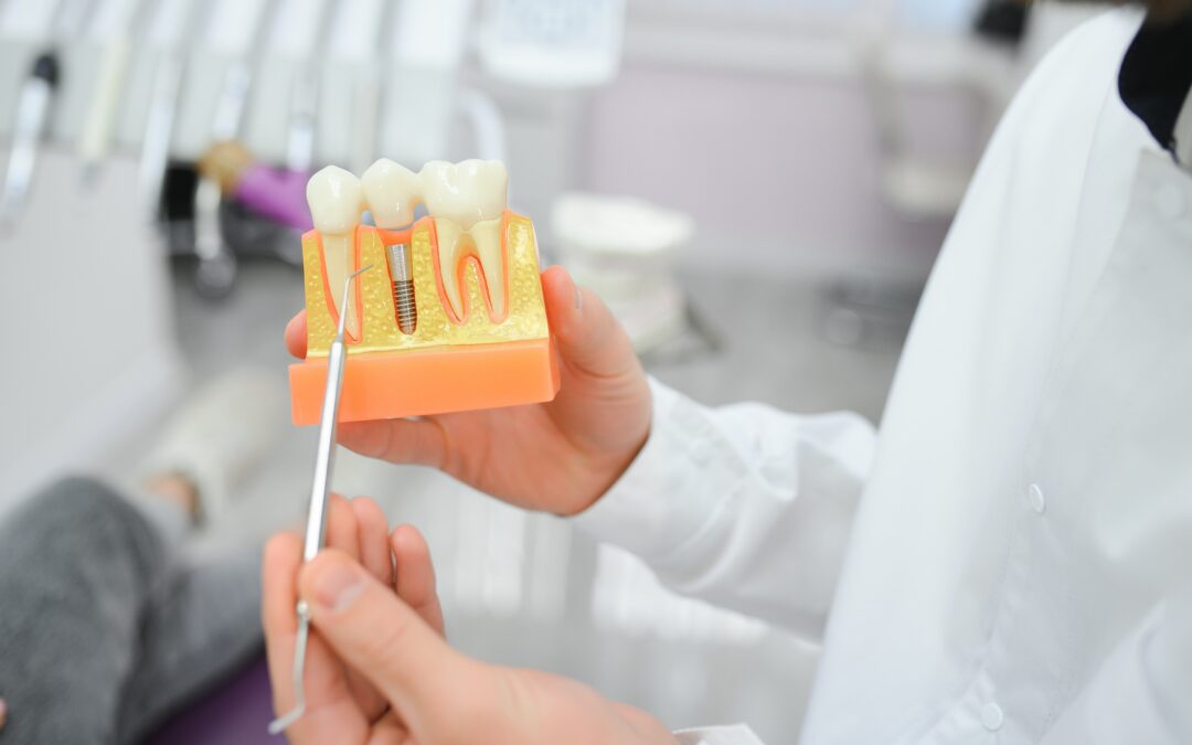 Are Dental Implants Worth It? Benefits That Might Surprise You