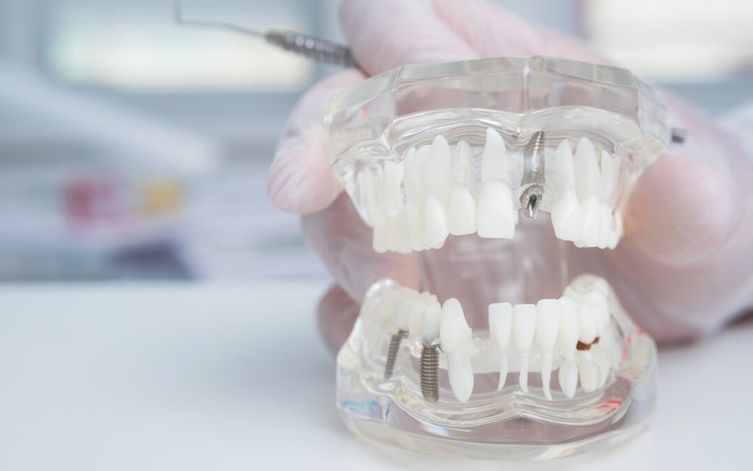 Are Dental Implants Natural-Looking?