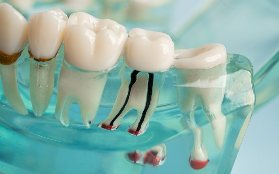 What to Expect During Healing After Your Implant Procedure