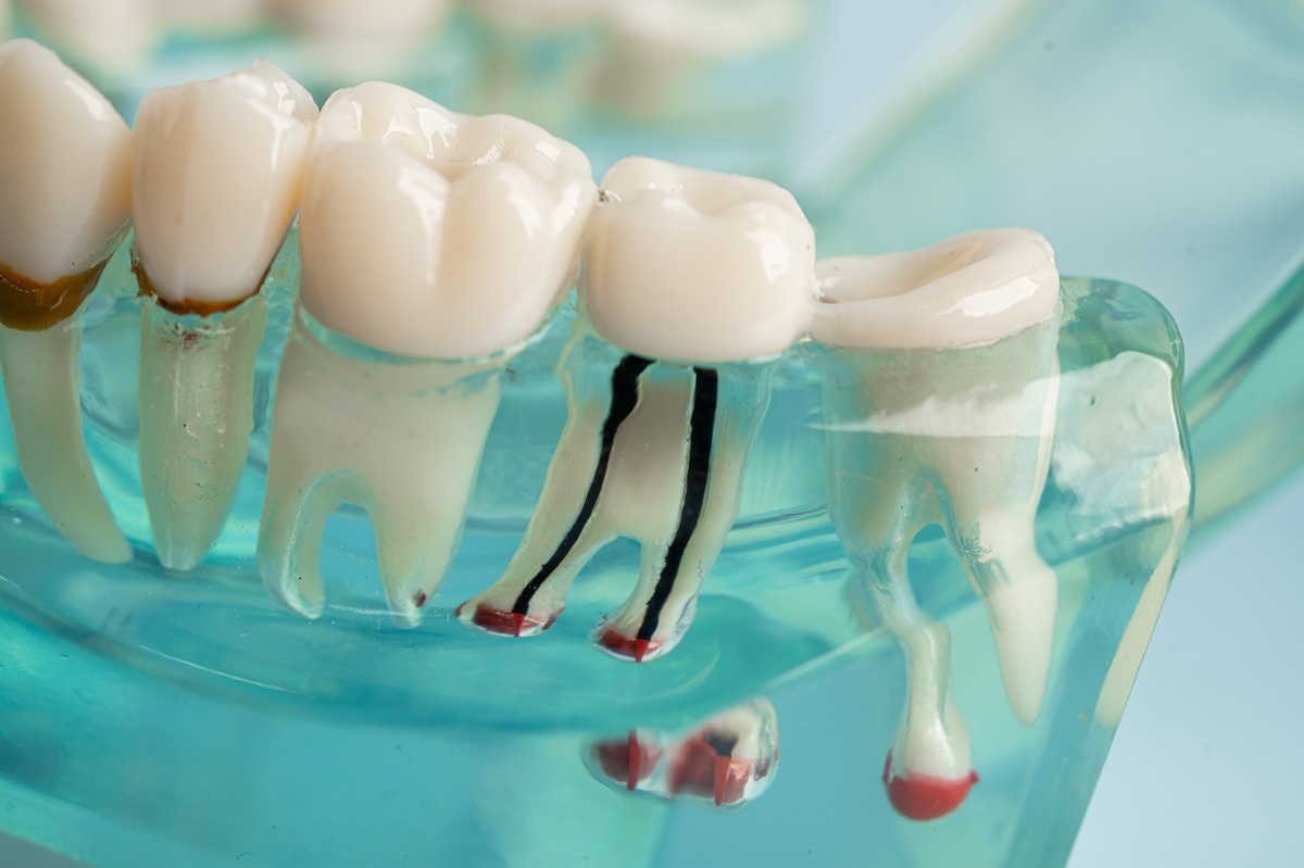 Close-up dental implant tooth structure