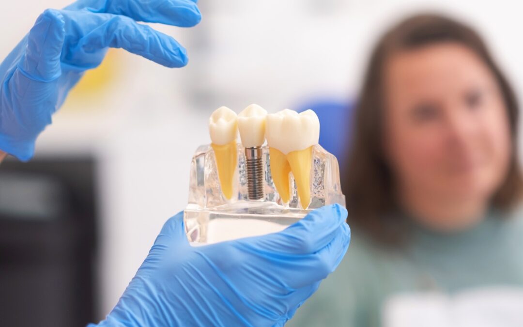 Common Myths About Dental Implants You Should Stop Believing