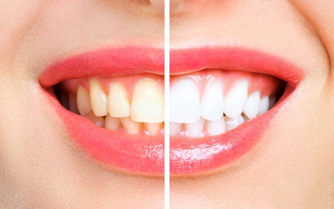 The Truth About Teeth Whitening: Separating Fact from Fiction
