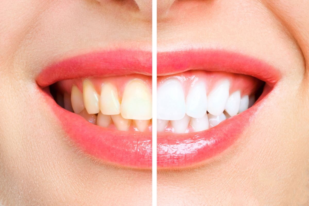 The Truth About Teeth Whitening