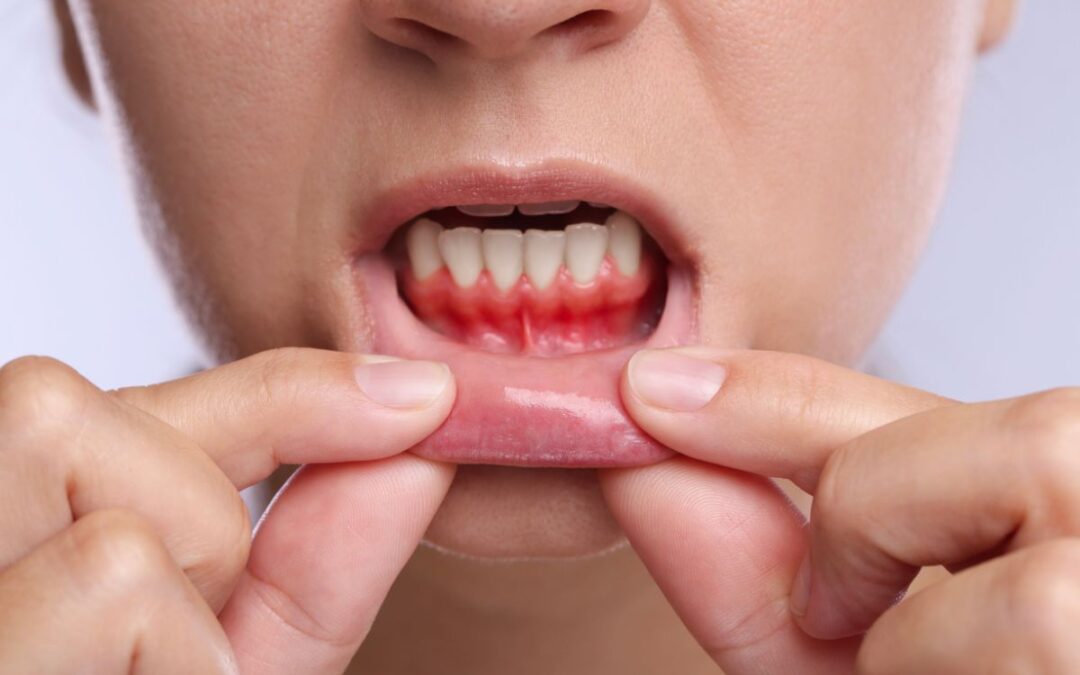 Why Gum Health Matters: Preventing and Reversing Gingivitis